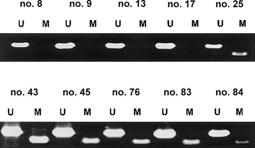 Fig. 5. SOCS-1 is frequently hypermethylated in MM patient samples. / Representative MSP results from primary MM samples are shown. Lane U indicates amplified product with primers recognizing unmethylated SOCS-1 sequence. Lane M indicates amplified product with primers recognizing methylated SOCS-1 sequence. None of these samples were enriched for plasma cells, so the occurrence of both signals in the same sample indicates either the presence of nonmalignant cells in the bone marrow aspirate or heterogeneity of aberrant methylation within the MM cell population.