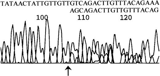 Fig. 3. DNA sequence derived from a heteroduplex fragment. / A heteroduplex band from patient no. 34 was isolated, reamplified, and sequenced. Note unambiguous sequence up to the arrowed nucleotide (T at nt 775 on the PIG-A cDNA sequence), then ambiguous sequence. By subtracting the normal sequence 775-GTCAGCAGACTTGTT from the observed sequence the alternative peaks can be clearly read as 778-AGCAGACTTGTTAC showing deletion of 3 nucleotides.