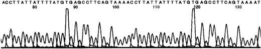 Fig. 4. DNA sequence showing a 31-nt duplication. / An abnormal band from patient no. 24 was isolated, reamplified, and sequenced. The duplicated sequence is shown overlined.