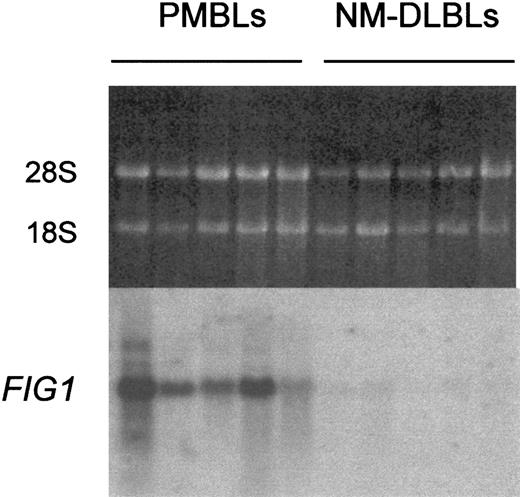 Fig. 1. Northern blot analysis of. / FIG1 expression in PMBL versus NM-DLBL. Total RNA (5 μg) extracted from the 5 original PMBLs and the 5 original NM-DLBLs used to generate RDA representations was loaded on each lane. Ethidium bromide–stained 28S and 18S rRNA bands are shown for comparison (top). Hybond N+ membrane was hybridized with the α-32P–labeled human FIG1 RDA fragment.
