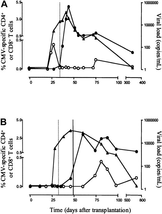 Fig. 1. Enumeration of CMV-specific CD4+ and CD8+ T cells in primary CMV infection. / Shown are the frequencies of CMV-specific CD4+ T cells, determined by intracellular staining for CD69 and IFN-γ on stimulation (○), CMV-specific CD8+ T cells, enumerated by tetramer binding (●), and first specific antibody appearance (dotted vertical line) in relation to viral load (CMV DNA, ▴) in one representative asymptomatic patient (patient 4, panel A) and one symptomatic patient (patient 8, panel B, closed vertical line, start of 14 days of ganciclovir therapy).