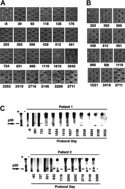 Fig. 5. Immune response to bovine protein and retroviral envelope. / (A) Ouchterlony gel of sera from patient 2 at various protocol days. Patient sera (center well); FCS, neat (well no. 1), diluted 1:4 (well no. 2), and 1:8 (well no. 3); bovine serum albumin neat (well no. 4), diluted 1:4 (well no. 5), and 1:8 (well no. 6). (B) Ouchterlony gel of sera from patient 2 (center well), bovine lipoprotein (well no. 1), FCS (well no. 2), lipoprotein-deficient bovine sera (well no. 3), bovine α-2 macroglobulin (well no. 4), bovine ceruloplasmin (well no. 5), Cohn fractions II/III containing primarily β and γ globulins (well no. 6). (C) Western blot assay of patients' sera obtained at various time points to detect antiretroviral antibodies. Each blot begins with a positive monkey serum control (+), followed by molecular weight markers (M) and then a control negative monkey serum (−).