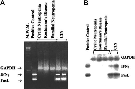 Fig. 7. IFN-γ and FasL expression in LTBMC stromal layers. / Total mRNA was extracted from adherent cells of confluent LTBMCs from patients and controls and subjected to RT-PCR analysis for IFN-γ and FasL expression using specific primers. PCR products were electrophoresed on a 1.5% agarose gel and visualized under ultraviolet light by ethidium-bromide staining. As positive controls for IFN-γ and FasL expression, cDNA was obtained from peripheral blood mononuclear (IFN-γ) or Jurkat (FasL) cells stimulated with phorbol myristate acetate (PMA;100 ng/mL) plus ionomycin (1 μM) for 4 hours. (A) RT-PCR detection of IFN-γ and FasL in cell cultures derived from positive controls and representative patients with CIN. Three samples derived from patients with cyclic, severe congenital (Kostmann disease) and familial neutropenia, respectively, were negative for IFN-γ and FasL and are also shown. GAPDH was used as a control for cDNA amplification. (B) Hybridization of RT-PCR products derived from the positive controls, the 2 CIN patients, and the 3 patients with cyclic, severe congenital, and familial neutropenia was performed using gene-specific primers to confirm the nature of the amplified products. MWM indicates molecular weight marker.