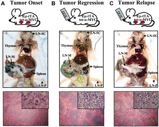 Fig. 1. Tumor regression and relapse on prolonged. / MYC inactivation. (A) Transplantation of tumor cells into a syngeneic recipient results in the animal becoming moribund with tumor burden, as demonstrated grossly by tumor invasion into thymus, lymph nodes, spleen, liver, and intestine and histologically by the effacement of spleen architecture. (B) AfterMYC inactivation with doxycycline treatment for 2 weeks, autopsy and histologic examination show evidence of complete tumor regression and the restoration of healthy spleen architecture. (C) After prolonged MYC inactivation, tumors can relapse, again invading the thymus, spleen, lymph nodes, liver, and intestine. Histologic specimens were stained with hematoxylin and eosin. Bottom panels show × 10 and × 60 (inset) images of the spleen. LN indicates lymph node; SC, superficial cervical; P, popliteal; M, mesenteric.