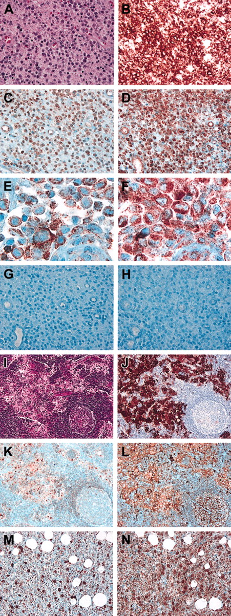 Fig. 1. CCR6 and CCR7 expression in histiocytic processes. / (A-H) Serial sections of LCH-involved lymph node, demonstrating coexpression of CCR6 and CCR7 by CD1a+ pathologic LCs. (A) Hematoxylin and eosin. (B) Anti-CD1a. (C) Anti-CCR6 showing pathologic LCs staining with variable intensities. (D) Anti-CCR7 showing uniform staining of all pathologic LCs (note endothelial cell staining as well). (E) Anti-CCR6 at high power showing typical LCH lesional cells all staining for CCR6. (F) Anti-CCR7 at high power showing cells in the same field and having the same morphology as those in panel E staining for CCR7. (G) IgG2B isotype control for anti-CCR6. (H) IgG1 isotype control for anti-CCR7. (I-L) Serial sections of RDD-involved lymph node, demonstrating coexpression of CCR6 and CCR7 in areas containing S100+ RDD histiocytes. (I) Hematoxylin and eosin. (J) Anti-S100. (K) anti-CCR6. (L) Anti-CCR7. Note reactive germinal center in the lower right portion of panels I-L in which B cells are CCR6− and CCR7+. (M-N) Serial sections of HPS-involved soft tissue, demonstrating coexpression of CCR6 and CCR7 by histiocytes. (M) Anti-CCR6. (N) Anti-CCR7; note large, intensely positive histiocytes in panels M and N. All panels are original magnification × 400, except for E and F, which are × 1000.