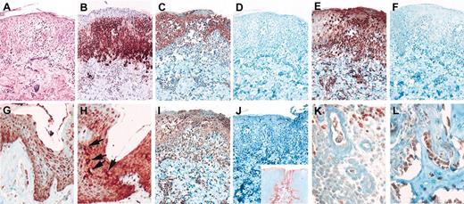 Fig. 2. MIP-3α/CCL20, CCR6, and CCR7 expression in LCH skin and bone lesions. / (A-F, I-J) LCH skin lesion. (A) Hematoxylin and eosin. (B) Anti-CD1a. (C) Anti-CCR6. (D) IgG2B isotype control for anti-CCR6. (E) Anti-CCR7. (F) IgG1 isotype control for anti-CCR7. (G) Nonspecific inflammatory skin lesion, anti-CCR6 showing keratinocyte staining. (H) Nonspecific inflammatory skin lesion, anti-CCR7 showing scattered cells with LC morphology staining intensely for CCR7 (arrows) as well as keratinocyte staining. (I) LCH lesion (same case as panels A-F), anti-MIP-3α/CCL20 showing staining of keratinocytes as well as infiltrating cells. (J) Buffer control for panel I; inset, anti-MIP3a/CCL20 staining of tonsil showing expression by crypt epithelium. (K) LCH bone lesion, anti-MIP-3α, showing intense staining of macrophages (top) and light staining of infiltrating pathologic LCs (left). (L) LCH bone lesion, anti-MIP-3α, showing staining of osteoblasts. Panels A-J are original magnification × 200; J inset is original magnification × 20; panels K and L are original magnification × 400.