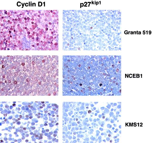 Fig. 2. Immunohistochemical analysis of t(11;14) cell lines for expression of cyclin D1 and p27Kip1. / Cyclin D1 positivity is seen in approximately 100%, 10%, and 60% of the cells in Granta 519, NCEB-1, and KMS12, respectively. In contrast, p27Kip1 is positive in 5%, 20%, and 10% of the cells in Granta 519, NCEB-1, and KMS12, respectively.