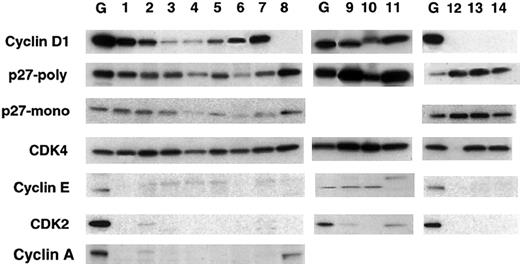 Fig. 3. Western blot analysis for cyclin D1, p27Kip1, and other cell cycle–related proteins in primary MCL. / Each lane contains 30 μg protein extract. Lane G represents the Granta 519 cell line control; lanes 1-7 represent 7 cases of typical MCL. Lanes 8 and 12-14 represent 3 control cases of CLL. Lanes 8 and 14 correspond to the same CLL case. Lanes 9-11 represent 3 cases of blastic MCL. Note that all the MCL cases express cyclin D1 and the CLL cases are negative for cyclin D1. p27Kip1 is expressed in all instances; however, its expression is highest in the blastic variant of MCL (lanes 9-11), followed by the CLL cases (lanes 8 and 12-14). Note that the expression of cyclin A, cyclin E, and CDK2 is very low in the typical MCL cases (lanes 1-7), whereas the expression of these proteins in the blastic variant of MCL is comparable to that of the cell lines. Cyclin A was not performed in the blastic cases because there was not enough tissue.