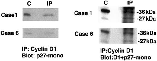 Fig. 4. Coimmunoprecipitation of p27Kip1 with cyclin D1 in primary typical MCL. / Protein extracts were immunoprecipitated with anticyclin D1. Western blots were probed with either p27Kip1 or cyclin D1 and p27Kip1. Lane C contains positive control and lane IP contains the case immunoprecipitated. In both cases p27Kip1protein is recovered from cyclin D1 immunoprecipitates.
