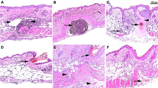 Fig. 2. Representative histologic sections of murine skin after tick infestation or suture placement. / (A) Marked purulent inflammation induced by 24 hours of suture placement in a CD11b−/− mouse. Arrow indicates hole in dermis where suture used to be. Arrowhead indicates neutrophilic inflammation. (B) Complete absence of neutrophilic response to suture in a CD18−/− mouse. Arrow indicates retained suture. (C) Minimal, primarily lymphocytic inflammation induced by 24 hours of tick feeding in a CD11b−/− mouse. Arrow indicates I scapularis mouth parts embedded in the dermis. Arrowhead indicates pink cement substance secreted by the tick to aid in firm attachment. Narrow, concave arrow indicates venules containing erythrocytes and nonextravasated leukocytes. (D) Minimal inflammation induced by 24 hours of tick feeding in a B6 mouse. Arrow indicates I scapularis mouth parts breaching the superficial epidermis. (E) Moderate hemorrhage induced after 72 hours of tick feeding in a B6 mouse. Arrow indicates remnants of I scapularis near epidermis. Arrowheads indicate hemorrhage and disruption of normal dermal tissue architecture. Note minimal leukocytic inflammation compared with abundant hemorrhage. (F) Moderate hemorrhage induced after 72 hours of tick feeding in a CD11a−/− mouse. Arrows indicate pools of hemorrhage and free erythrocytes dissecting up through muscle layer of dermis.
