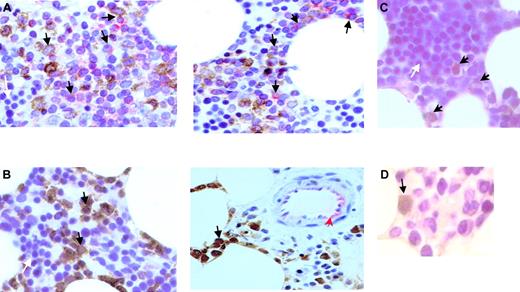 Fig. 1. Immunohistochemical analysis of bone marrow biopsies. / Immunohistochemistry was performed as described in detail in “Methods.” (A) Approximately 40% to 50% of leukemic blasts (black arrows) showed coexpression of CD34 and CD117. Erythropoietic cells (white arrow) are negative for CD34 and CD117. (B) Day 118 after imatinib mesylate therapy: leukemic blasts with coexpression of CD34 and CD117 are not present. Some regenerating immature myeloid precursor cells (black arrows) show CD117 positivity. Endothelial cells of marrow arterioles show reactivity for CD34 (red arrow), serving as an internal positive control. Erythropoietic cells (white arrow) are negative for CD34 and CD117. (C) Positive staining by means of an antiphospho–c-Kit (Tyr719) antibody indicated activation of c-Kit. Black arrows show phospho–c-Kit+ blasts. Erythropoietic cells (white arrow) serve as internal negative control. (D) Prior to imatinib mesylate, approximately 10% of leukemic blasts showed expression of Fas (black arrow). Upon complete remission, fewer than 5% of blasts were left for analysis. In this situation, only an occasional Fas+ blast was found (data not shown). Original magnifications × 100 (A-C) and × 150 (D).