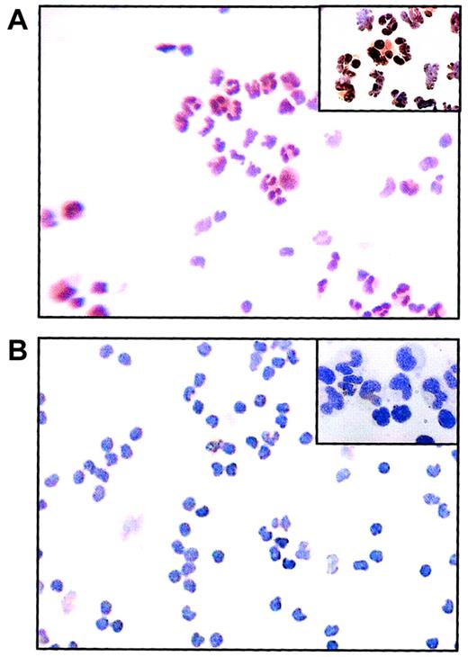 Fig. 1. Immunocytochemical stained cytospins for JunB. / (A) In cells from healthy individuals, most cells are positively stained (brown) for JunB antibody. (B) In cells from CML patients, few cells are positively stained and most cells are negatively stained for JunB antibody. JunB antibody staining was detected using peroxidase with DAB substrate. Cells were counterstained with nematoxylin. Original magnifications × 100, × 1000 for insets.