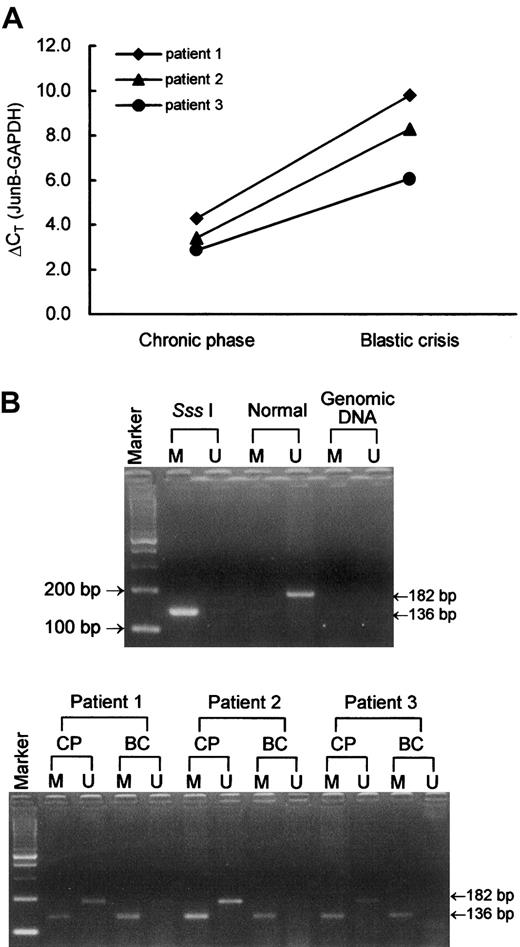 Fig. 2. JunB gene expression and methylation-specific PCR. / (A) JunB gene expression levels of 3 representative CML cases as measured by real-time quantitative RT-PCR. In each CML patient, JunB expression level was higher (lower ΔCT) at chronic phase and was lower (higher ΔCT) at blastic crisis. (B) Methylation-specific PCR of JunB. Sss I is Sss I–treated, bisulfite-modified DNA of a healthy individual. This DNA sample was used as a positive control for methylation-specific primers. Normal is bisulfite-modifed DNA of the same healthy individual as in lane Sss I Tx. Genomic DNA is unmodified gDNA of a CML patient. M and U indicate methylation-specific PCR using JunB-M and JunB-U primer sets, respectively. CP and BC indicate chronic phase and blastic crisis of CML, respectively. Marker represents the 100-bp ladder DNA marker. Patients 1, 2, and 3 correspond to the same patients in panel A.