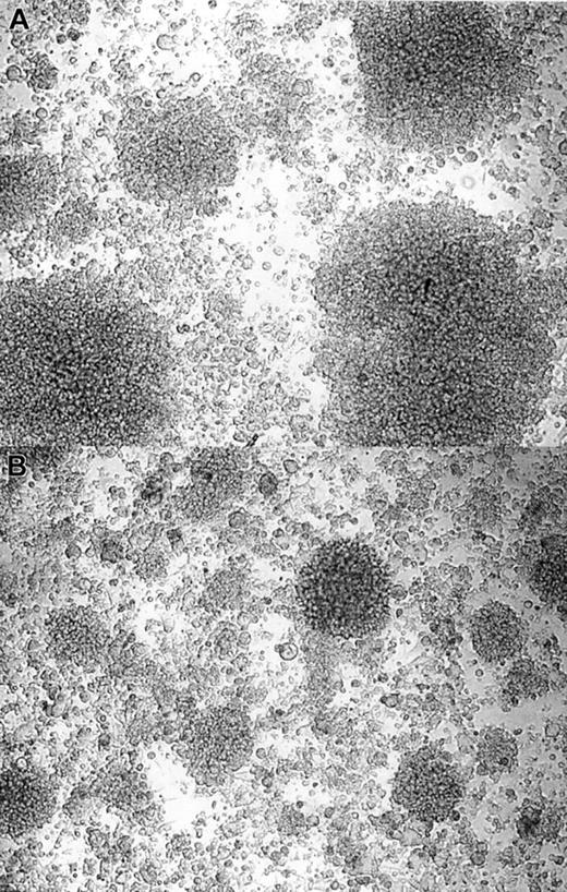 Fig. 2. IVIGs reduce B-lymphocyte aggregation in the culture system. / Purified human B lymphocytes were cultured in the presence of irradiated L4.5 and IL-4 with 4 mM glycine and 10 mg/mL BSA (A) or with 10 mg/mL dialyzed IVIGs (B). Fibroblastic L4.5 single cells in the background are supporting the growth of B lymphocytes in large or small clusters; pictures were taken on day 8 at a × 100 magnification. These results are representative of 3 independent experiments with both IVIG preparations.