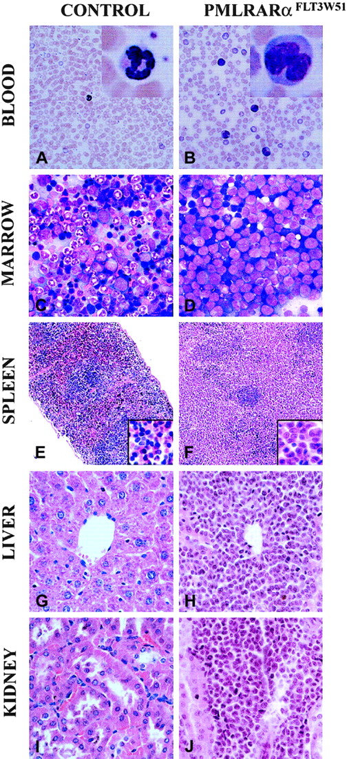 Fig. 2. Combination of activated FLT3 and PML-RARα results in aggressive disseminated acute myeloid leukemias. / (A,C,E,G,I) Healthy FVB/N control. (B,D,F,H,J) Representative findings of leukemic-activated FLT3/PML-RARα mice. (A-B) Peripheral blood. Leukocytosis, including immature forms/blasts with indented nuclei, is present in leukemic mice. Comparisons of normal neutrophil with abnormal immature form/blast (insets). (C-D) Bone marrow smears. Leukemic marrow is filled with immature forms/blasts, many with numerous azurophilic granules. (E-F) Spleens. Leukemic spleen has red pulp effaced with leukemic cells; insets show red pulp at higher magnification. (G-H) Livers. Leukemic cells are present in periportal areas and infiltrate the sinusoids. (I-J) Kidneys. Leukemic cells infiltrate the kidney focally. (A-D) Wright-Giemsa stain. (E-J) Hematoxylin and eosin stain. Original magnification × 400 (A-D, G-J). Original magnification × 2400 (A-B, insets). Original magnification × 100 (E-F; insets, × 400).