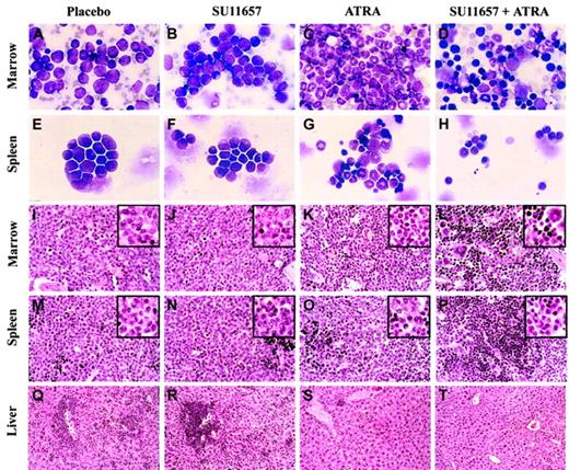 Fig. 7. FLT3 inhibition cooperates with ATRA to rapidly restore normal hematopoiesis. / Cytology and histopathology of representative mice treated as described in the legend to Figure 6. (A-D) Bone marrow cytology. ATRA causes differentiation of leukemic immature forms/blasts to neutrophilic cells, whereas SU11657 + ATRA restores a heterogeneous bone marrow with healthy elements. (E-H) Splenic cytology. ATRA-induced differentiation is evident along with normal lymphocytes and erythroid cells. SU11657 + ATRA spleen contains many healthy small lymphocytes. (I-L) Bone marrow histopathology. Findings are consistent with those observed in cytology preparations. (M-P) Splenic histopathology. SU11657 + ATRA restores normal splenic architecture. (Q-T) Liver histopathology. ATRA and SU11657 + ATRA cause marked regression of the leukemia from the liver. Wright-Giemsa stain; original magnification × 250 (A-H). Hematoxylin and eosin stain (I-T). Original magnification × 125; insets × 250 (I-P). Original magnification × 50 (Q-T).