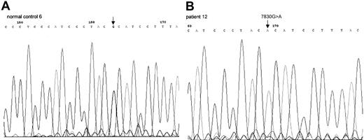 Fig. 2. Sequence chromatogram of PCR-amplified mtDNA. / COII gene from healthy control 6 (A), patient 12 (B). This 7830G>A mutation led to amino acid change from Arg to His.