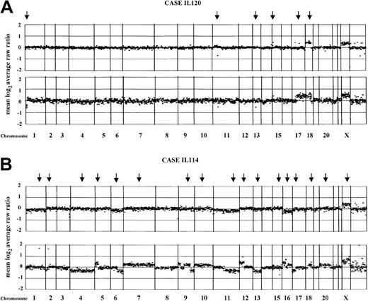 Fig. 1. Normalized copy number variation analysis of paired FCL and DLBCL samples using array CGH. / The figures represent the normalized copy number ratios of genomic DNAs from patients IL120 (A) and IL114 (B). For each figure, the initial FCL biopsies are placed above the posttransformation biopsies (lower panel). Data are plotted as the mean log2 ratio of the triplicate spots for each clone normalized to the genome median log2 ratio. The BAC and P1 clones are ordered by position in the genome, beginning at chromosome 1p and ending at chromosome Xq. Borders between chromosomes are indicated by vertical bars. Arrows indicate genomic changes, which are summarized in Table 1. (A) In both samples from the case IL120, gain of chromosome 18q confirms the clonality of the paired biopsies. In addition, a deletion of approximately 2.3 Mb in 11p14 and a single-copy DNA gain of approximately 1 Mb in 15q14 also were seen. In the transformed biopsy, novel changes included the loss of the terminal portion of chromosome 1p36 (sized approximately 10 Mb), deletion of approximately 1 Mb involving the RB gene locus in 13q14, and gain of the whole arm of chromosome 17. (B) The FCL biopsy from the case IL114 (tumor cell population of 85%) is shown. According to the defined log2 ratios, no changes were observed in the FCL sample. In the transformed biopsy, a number of acquired aberrations are seen, including single-copy DNA alterations of chromosomes 6, 11, and 16, and high-level amplification affecting 1q24 (clone RP11-184N12; log2 ratio + SD, + 1.7 + 0.036), 2p16 (REL/BCL11A gene locus; log2 ratio + SD, + 1.67 + 0.068), and 12q12 (clone RP11-29G23; log2ratio + SD, +0.96 + 0.059).
