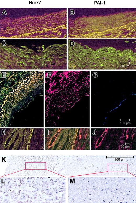 Fig. 5. Nur77 and PAI-1 expression in normal and atherosclerotic vascular tissues. / (A-D) Minimal expression for Nur77 (A) and PAI-1 (B) in normal vessels; high expression of both proteins in the plaque area in endothelial cells and smooth muscle cells in an atherosclerotic coronary artery (C-D). The 50-μm scale bar in panel D applies to panels A-D. (E-G) Coimmunostaining of Nur77 and PAI-1 in a human atherosclerotic lesion. The vessel was stained for Nur77 (green, E), PAI-1 (red, F), or CD31 (blue, G). The 100-μm scale bar in panel G applies to panels E-G. (H-J) Endothelial cells of vasa vasora in human atherosclerotic coronary arteries express both Nur77 (H) and PAI-1 (J), which colocalize (I). The 20-μm scale bar in panel J applies to panels H-J. (K-M) Expression of Nur77 in a human atherosclerotic vessel (K) with higher expression in the neointima (L) and lower expression in the media (M). Panels L and M show further magnification of the indicated areas of panel K.