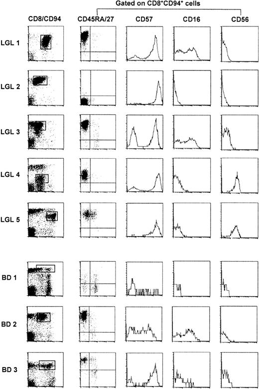 Fig. 1. FACS analysis of TLGL cells and of their CD8+CD94+ counterparts in 3 blood donors. / BD 1 is representative for most healthy blood donors whereas BD 2 and BD 3 are examples of blood donors with high numbers of CD8+CD94+ T cells. Cells of patients with TLGL leukemia are marked LGL 1-5; blood donor cells are marked BD 1-3.
