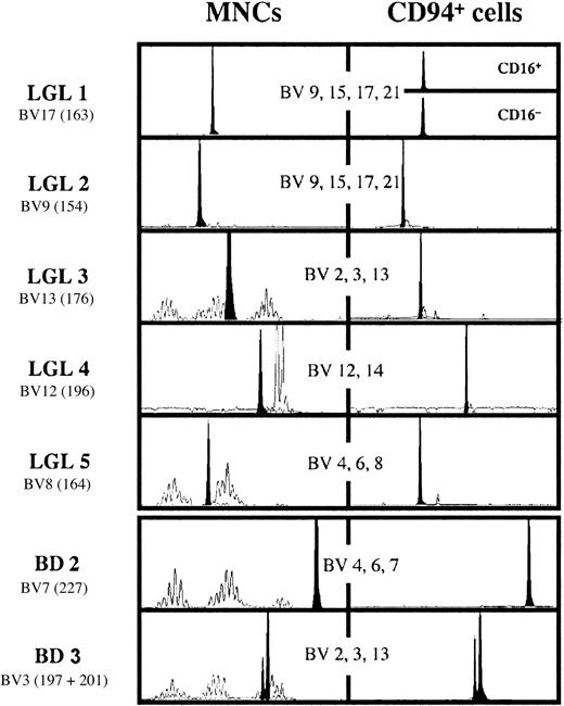 Fig. 2. Spectratype analysis of the T-cell repertoire in LGL 1-5 and in the 2 blood donors with large expansions of CD8+CD94+ T cells. / The analysis has been performed for 21 BVs in 8 pools containing the specific primers for 2-4 BV families. Only the data of the pool with the BV depicted in the figure containing the BV of the dominant clone are shown. For each graph, the number in parentheses represents the size of the amplified fragment by Genescan analysis. The double peak in BD 3 has been authenticated by analysis with BJ-specific primers. The clone BV3197 uses the BJ2.5 segment, whereas the clone BV3201 uses the BJ2.7 segment.