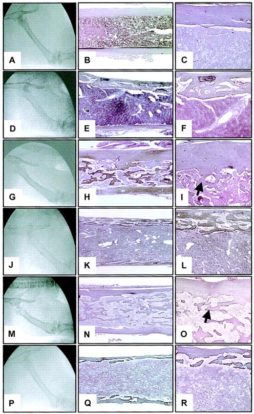 Fig. 4. Radiographic and histologic sections of the femurs of WT and. / opg−/− hosts engrafted with WT oropg−/− TPO-overexpressing BM cells.Representative photographs from a WT control (A-C) and a 3-month-oldopg−/− control (D-F) are shown for comparison. The middle column shows longitudinal sections of femurs stained according to Gordon-Sweet (original magnification × 25). Details of the femoral cortical area are illustrated in the right column (original magnification × 60). Histologic sections are stained according to Gordon-Sweet. Note decreased bone mineral radiodensity (D) and severe cortical bone porosity in theopg−/− control (E-F). (G) Radiograph of the femur of a WT host engrafted with WT donor cells. Note significant radiodensification of the bone. (H-I) Representative histologic section of the femur shows the presence of numerous bone trabeculae (arrow) occluding the femoral cavity. (J) Radiograph of the femur of anopg−/− host engrafted withopg−/− donor cells shows poorly defined cortical region and significant loss of radiodensity. (K-L) Severe osteoporosis is confirmed histologically. (M) Radiograph of the femur of a WT host engrafted with opg−/− donor cells. Increased bone density is seen. (N-O) Representative histologic section of the femur shows osteosclerosis with accumulation of bone trabeculae in the shaft (arrow). (P) Radiograph of the femur of anopg−/− host engrafted with WT donor cells. Note thinning of the cortical region and decreased bone density. (Q-R) Histologically, the femur is profoundly osteoporotic with a porous cortical region. Radiography and histology were from the same animals examined 3 months after transplantation. Similar results were observed in 3 mice per experimental groups.