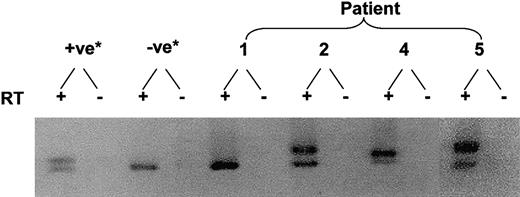 Fig. 4. Demonstration of the FLT3 ITD in AML blasts. / Total RNA was extracted from 1 × 106 to 5 × 106 blast cells. PCR was performed on total cDNA with specific primers flanking exon 11 and 12 of the FLT3gene where the ITD usually occurs. *The positive control (+ve) was an AML sample previously shown to contain this mutation, and the negative control (-ve) was cDNA from cells from a patient with acute lymphoblastic leukemia that did not show the Flt-3 ITD.