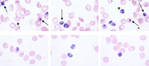 Fig. 3. Morphologic appearance of. / P falciparum in CC and AA cells. Parasite clone GB4 was cultured for 4 days in either AA or CC cells, stained with Giemsa, and observed by light microscopy (× 1000). Although healthy forms (asterisks) were noted in CC cells, typically half of all parasites appeared to be unhealthy, as indicated by fragmentation of ring forms and blurring of trophozoites and schizonts (top panels arrows). The healthy condition of parasites in AA cells is shown for comparison (bottom panels).
