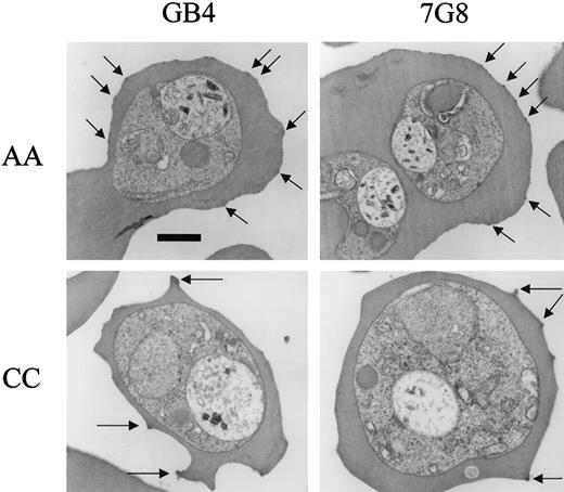 Fig. 6. Electron micrographs of. / P falciparum knobs in AA and CC cells. Parasites were cultured for 4 days in AA or CC cells and trophozoite-infected cells observed by electron microscopy. Knobs (arrows) were fewer in number and more protuberant on CC than on AA cells. Bar represents 1 μm.