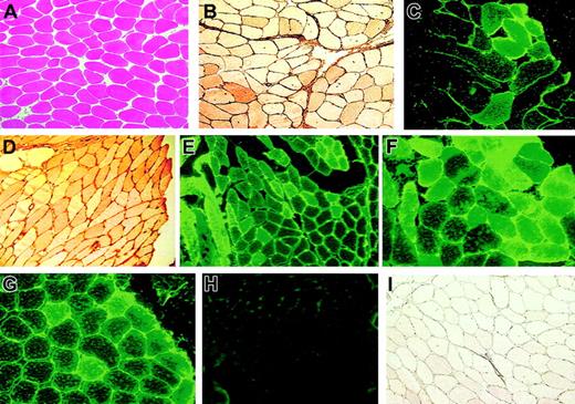 Fig. 3. Histology of skeletal muscle cross-sections of biopsy taken 2 months after vector administration. / (A-C) Subject D, hematoxylin and eosin (A), F.IX immunohistochemistry (B, brown stain), and F.IX immunoflourescence stain (C, green stain). (D-G) Subject G F.IX immunohistochemistry (D, brown stain), and F.IX immunofluorescence stain (E-G, green stain). (H-I) Sections that stained negative for F.IX expression by immunohistochemistry (H) and immunofluorescence (I) methods for comparison. Original magnifications × 100 (A-B, D-E, H-I) and × 200 (C, F-G).