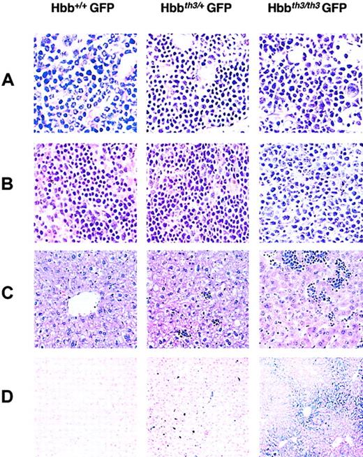 Fig. 3. Histopathologic analysis of hematopoietic tissues in Hbb+/+, Hbbth3/+, and Hbbth3/th3 chimeras. / (A) Bone marrow (original magnification, × 60). Left: Hbb+/+ control. The marrow shows various stages of normal erythroid maturation. Megakaryocytes as well as a significant numbers of maturing myeloid cells are present. Center: Hbbth3/+ control. The marrow shows a relative increase in erythroid elements; some myeloid cells are still present. Right: Hbbth3/th3 chimera. Misshapen erythroid cells and red cell fragments are present in the sinuses. Some of the immature erythroid cells have dysmorphic nuclei. Mature erythroid cells are decreased. (B) Spleen (original magnification, × 60). Left: Hbb+/+ control. The red pulp contains a mixture of erythroid and myeloid cells. The sinuses are open. Center: Hbbth3/+ control. Significant expansion of red pulp compressing the sinuses. Right: Hbbth3/th3 chimera. The red pulp consists primarily of immature erythroid cells. Mitotic figures are easily identified. The immature erythroid cells often have abnormal nuclei. (C) Liver (original magnification, × 20). Left: Hbb+/+ control. EMH is absent. Center: Hbbth3/+ control. Moderate EMH is present. Right: Hbbth3/th3 chimera: Extensive EMH is present. (D) Liver (original magnification, × 20), Gomori stain). Left: Hbb+/+ control: undetectable iron. Center: Hbbth3/+ control. Moderate iron deposits predominantly in Kuppfer cells. Right: Hbbth3/th3 chimera: Diffuse iron accumulation, concentrated in the cytoplasm of the hepatocytes preferentially around the portal tracts. Control tissues from mice engrafted with eGFP-transduced Hbb+/+ or Hbbth3/+ FLCs were harvested 6 and 8 months after transplantation. Tissues from control Hbbth3/th3 chimeras were harvested 8 weeks after transplantation. Stained with hematoxylin and eosin (A-C).
