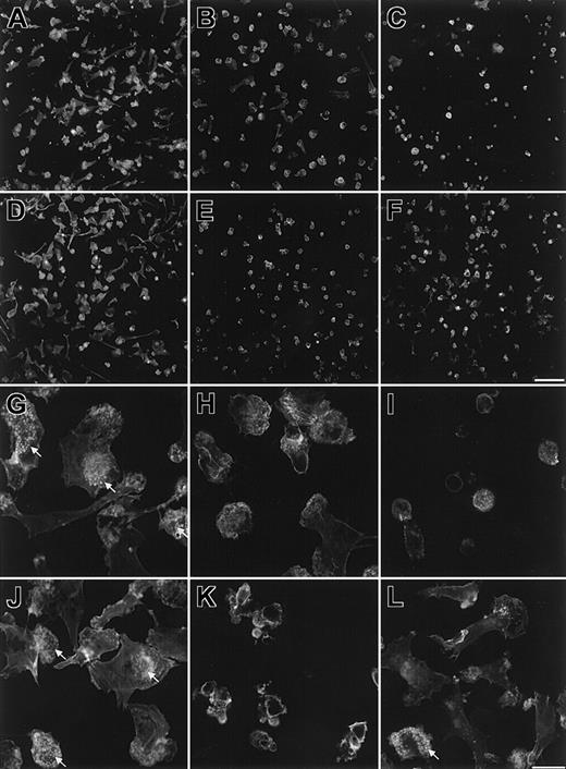 Fig. 1. CML-DCs have altered morphology and F-actin distribution. / DCs were allowed to adhere to fibronectin-coated glass coverslips for 4 hours and were then fixed and stained with tetramethyl B rhodamine isothiocyanate (TRITC)–labeled phalloidin to show F-actin. Images are shown of 2 independent preparations of normal DCs (A,D,G, and J) and for CML-DCs from patient 1 (B,H), patient 2 (C,I), patient 3 (E,K), and patient 6 (F,L). Low-magnification images (A-F) were collected with a cooled charge-coupled device (CCD) camera (scale bar in panel F represents 100 μm) and high-magnification images (G-L) with a confocal laser scanning microscope (scale bar in panel L represents 20 μm). Arrows indicate regions within cells that contain clusters of podosomes.