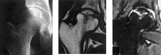 Fig. 4. Avascular necrosis of the hip. / Standard radiography versus MRI as a tool for the diagnosis of avascular necrosis. These panels illustrate that standard radiography could be strictly normal at the first clinical sign while MRI is already highly abnormal. The top panel shows the normal appearance of the hip using standard radiography. The middle and bottom panels show 2 different MRI sequences showing that, although the femoral head is still spherical, the adjacent bone is already affected with necrosis, with even cartilage modification.