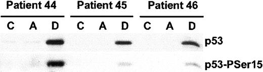 Fig. 5. Acadesine does not induce p53 accumulation or phosphorylation. / Cells from B-CLL patients were untreated (C), or treated with 0.5 mM acadesine (A) or 0.8 μM doxorubicin (D) for 24 hours. Cells were lysed and analyzed by Western blot as described in “Patients, materials, and methods.” Total levels of p53 and p53 phosphorylated at Ser15 were analyzed. Results of 3 representative patients of 5 analyzed are shown.
