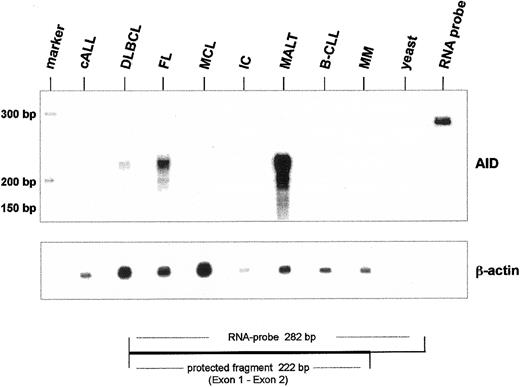 Fig. 5. Ribonuclease protection for AID mRNA in human non-Hodgkin lymphoma. / Total RNA (10 μg) from human NHL was hybridized with α–32P-labeled AID antisense RNA probe (nt 232-10). After RNA digestion the protected AID antisense RNA was analyzed on a denaturing polyacrylamide sequencing gel. As an internal standard, ribonuclease protection was performed for β-actin mRNA (lower panel). Yeast RNA (yeast) was used as a negative control, and undigested antisense RNA probe was run aside.