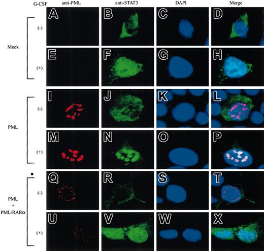 Fig. 5. STAT3 colocalizes with PML but not with PML/RARα in NBs. / 293T cells were transfected with STAT3 and G-CSF-R/gp130, together with a mock vector (A-H), PML alone (I-P), or PML + PML/RARα (Q-X). Cells were stained with an anti-PML Ab (A,E,I,M,Q,U), an anti-STAT3 Ab (B,F,J,N,R,V), and DAPI (C,G,K,O,S,W). Original magnifications, ×400.