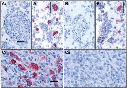 Fig. 1. Evaluation of the specificity of the c-Rel antisera used by transfection and competition experiments. / (A-B) Transfection experiments. HEC 293 cells were transiently transfected with the Rc/CMV2 plasmid containing full-lengthREL cDNA (Aii and Bii) or with the Rc/CMV2 vector alone (Ai and Bi). In immunocytology with antisera 265 (A) and 1136 (B) on the paraffin sections of the pelleted cells, immunoreactivity is restricted to cells transfected with the vector containing full-lengthREL cDNA. Note that staining in some cells is exclusively localized in the nucleus (see inserts Aii,Bii); bar equals 37.5 μm; inset magnification, bar equals 18 μm. (C) Competitive experiments. cHL14 revealed a strong cytoplasmic and nuclear staining for c-Rel with c-Rel antisera 265 (Ci). Specificity of the staining was confirmed by complete absence of staining after simultaneous incubation with a specific peptide (Cii); bar = 25 μm. Stains described in “Materials and methods.”