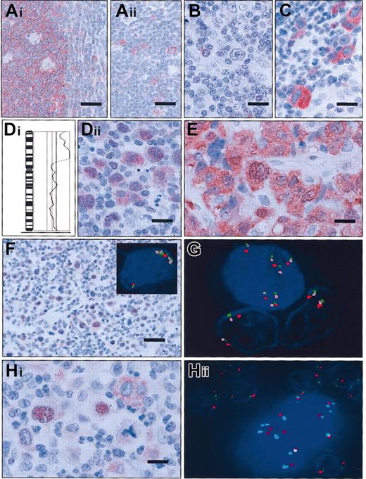 Fig. 2. Expression of c-Rel protein and detection of changes of the. / REL locus in tonsillar tissue and in classical Hodgkin lymphoma. (A) In lymphofollicular tonsillar hyperplasia, the germinal center B cells stain c-Rel+ predominantly in the cytoplasm; follicular dentric cells and macrophages are c-Rel− (Ai). In the extrafollicular region (Aii), intermingled immunoblasts are c-Rel+; bars = 37.5μm. (B) In cHL1, with balanced genomic status for REL by CGH and FICTION, the HRS cells are c-Rel protein−; bar equals 25 μm. (C) Strong c-Rel staining is limited to the cytoplasm in the vast majority of HRS in cHL3, with balanced genomic status forREL; bar equals 25 μm. (Di) Partial CGH karyotype of cHL24 showing a high-level DNA amplification on the short arm of chromosome 2 including chromosomal bands 2p13-p16, as shown by the massive deviation of the ratio profile to the right. In this case, REL was shown to be amplified by FICTION analysis. (Dii) Immunohistochemically, the HRS cells of the case shown in Di show accumulation of c-Rel in the nucleus and in the cytoplasm; bar equals 25 μm. (E) cHL with a t(2;22)(p16;q12) showing a strong cytoplasmic and nuclear staining of c-Rel in HRS cells; bar equals 15 μm. (F) Immunhistochemistry of cHL15 reveals a consistent c-Rel nuclear staining of HRS cells; bar equals 37.5 μm. The inset figure shows a multicolor FICTION assay of this cHL sample combining FISH with probes for the REL(green) and BCL11A (pink) loci as well as for the centromere of chromosome 2 (CEP2; red) and simultaneous detection of the c-Rel protein using antiserum 265 (blue). The depicted Hodgkin cell displays a nuclear c-Rel expression and an amplification of the RELand BCL11A oncogene loci indicated by a number of green and pink signals clearly exceeding that of the red centromeric probe. (G) Application of the same multicolor FICTION assay as in panel F to cHL18. The Hodgkin cell with 5 copies of the centromere of chromosome 2 and 7 copies of the REL and BCL11A loci has strong nuclear c-Rel positivity; 2 bystander cells with regular signal patterns for the REL and BCL11A loci display only background staining of c-Rel. (Hi) Example of heterogeneous c-Rel expression in HRS cells (cHL5). Two HRS cells show strong nuclear positivity for c-Rel, while the HRS cell on the upper right side has staining limited to the cytoplasm; bar equals 15 μm. (Hii) FICTION assay of the same cHL sample as in Hi, combining the c-Rel antiserum 265 (blue) with probes for REL (green) and the centromere of chromosome 2 (CEP2; red). The binucleated HRS cell containing supernumerary copies of the REL locus as compared with the number of signals for CEP2 shows strong nuclear and slight cytoplasmic c-Rel staining; as internal control, surrounding bystander cells feature a regular hybridization pattern. Note that in the HRS cell the size of several signals derived from the REL probe is larger than that located in the nuclei of bystander cells. This is caused by the presence of small duplications involving theREL locus.