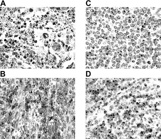 Fig. 1. Granzyme M (GM) expression in T-cell and NK-cell lymphomas. / (A) Nasal NK/T-cell lymphoma (nasal biopsy) with exuberant apoptotic necrosis. Apoptotic and viable tumor cells are strongly GM+. (B) Hepatosplenic γδ T-cell lymphoma (splenectomy specimen). Cordal and intrasinusoidal lymphomatous cells show intense GM positivity. (C) Intestinal T-cell lymphoma with medium-sized cells (resection specimen). Lymphoma cells reveal GM expression in the Golgi region. (D) Peripheral T-cell lymphoma of unspecified subtype (lymph node biopsy). There is an infiltrate predominantly composed of medium-sized cells with strong GM positivity in most cells.