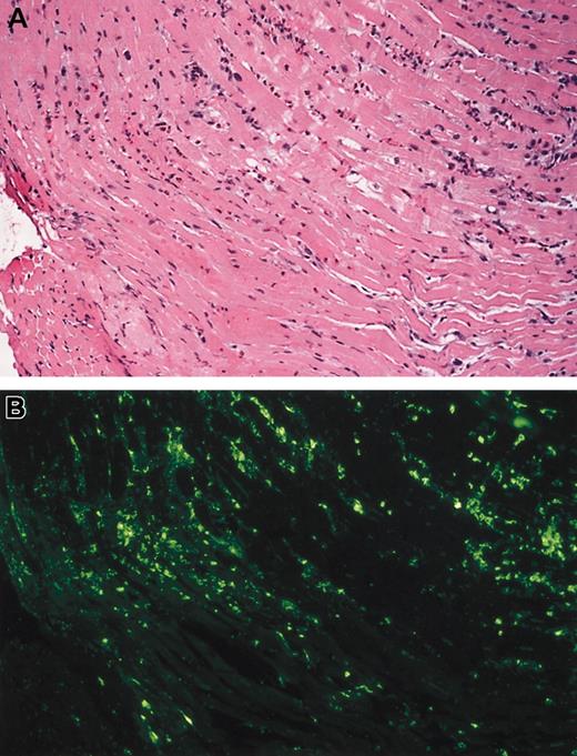 Fig. 1. Eosinophil infiltrate and degranulation. / (A) Eosinophilic myocarditis (case 1). Low-power photomicrograph showing the presence of a patchy interstitial infiltrate of eosinophils. These infiltrates were focally associated with myocyte damage (hematoxylin-eosin). (B) Eosinophil major basic protein (MBP). Step section of microscopic field shown in (A) stained for eosinophil MBP. Note marked MBP deposition, much of it extracellular, indicating eosinophil degranulation (immunofluorescence). Original magnification for both panels, × 100.