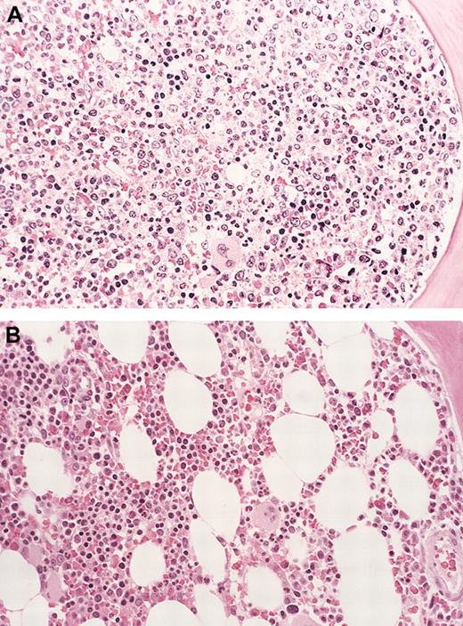 Fig. 2. Bone marrow eosinophil cytoreduction with imatinib therapy (case 6). / Hematoxylin-eosin (H&E)–stained bone marrow biopsy tissue (A), showing markedly hypercellular marrow with left-shifted granulopoiesis and eosinophilia before treatment with imatinib. (B) Shows the dramatic reduction in marrow cellularity with normal trilineage hematopoiesis after imatinib therapy (at 16 weeks). Original magnification for both panels, × 160.