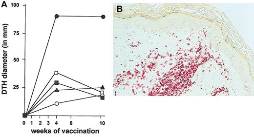 Figure 2. Intranodal vaccination with KLH-pulsed semimature DCs induces strong DTH reactivity to KLH. (A) Quantitation of the KLH-specific immune response by assessment of DTH reactivity to KLH in vivo. DTH reactivity to KLH was tested at week 0, 4, and 10 by intradermal injection of 5 μg KLH in 200 μL sterile PBS into the forearm. 48 hours after the challenge maximal diameter of the elicited indurated erythema was assessed. ▪ indicates patient 1; •, patient 2; ▴, patient 3; □, patient 4; and ○, patient 5. (B) Immunhistochemical characterization of the lymphocytic infiltrate at the DTH site. Alkaline-phosphatase-antialkaline phosphatase (APAAP) staining with a CD45RO mAb was performed, demonstrating a strong perivascular and epidermal infiltration of CD45RO+ memory T cells. Original magnification, × 100.