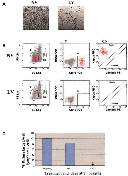 Figure 4. Purging effect of reovirus on DLBCL cells. (A) Cytopathic effect of reovirus on DLBCL cells 48 hours after infection. Purified cells were infected with 40 MOI live virus. Photomicrographs were taken at 48 hours after infection (original magnification, × 200). Significant cytopathic effect indicative of widespread killing was observed in live virus-treated but not in untreated cells. (B) Flow cytometric analysis of DLBCL following reovirus purging. Apheresis product cells were mixed with DLBCL cells (10%) and purged for 2 days with reovirus. Samples were analyzed using region C and lineage gate D (CD10-CD19+) to enumerate κ monoclonal CD10-CD19+ malignant cells (region C + D). Flow count beads were included in the CAL region to calculate absolute counts. (C) Representative histograms of viable DLBCL cells before and after purging with reovirus. Arrow indicates the absence of DLBCL cells.