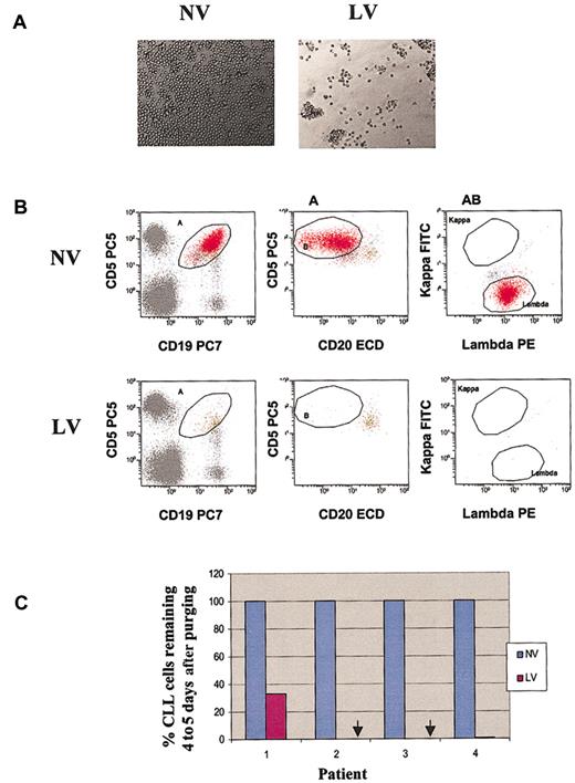 Figure 5. Purging effect of reovirus on CLL cells. (A) Cytopathic effect of reovirus on human CLL cells 72 hours after infection (original magnification, × 200). Purified cells were infected with 40 MOI live virus. Photomicrographs were taken at 72 hours after infection. Significant cytopathic effect was evident in reovirus-treated cells. (B) Flow cytometric analysis of CLL following reovirus purging. Apheresis product cells were mixed with CLL cells (10%) and purged for 4 to 5 days with reovirus. CLL was detected using a CD5+CD19+ region (gate A) combined with 5+ dim 20+ region (gate B) to detect monoclonal λ B cells (gate A + B). (C) Representative histograms of viable CLL cells for 4 patients following reovirus purging. Arrows indicate that CLL cells for patients 2 and 3 after virus treatment was not detected.