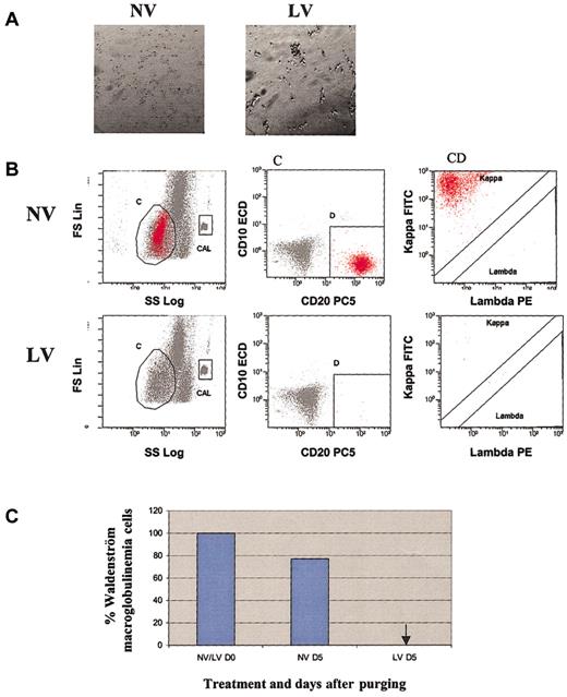 Figure 6. Purging effect of reovirus on Waldenström macroglobulinemia cells. (A) Cytopathic effect of reovirus on human Waldenström macroglobulinemia cells 72 hours after infection. Original magnification, × 200. Purified cells were infected with 40 MOI reovirus. Photomicrographs were taken at 72 hours after infection. Significant cytopathic effect was observed in live virus-treated but not in untreated cells. (B) Flow cytometric analysis of Waldenström macroglobulinemia following reovirus purging. Apheresis product cells were mixed with Waldenström macroglobulinemia cells (10%) and purged for 5 days with reovirus. Samples were analyzed using region C and lineage gate D (CD10-CD20+) to enumerate κ monoclonal CD10-CD20+ malignant cells (region C + D). Flow Count beads were included in the CAL region to calculate absolute counts. (C) Representative histograms of viable Waldenström macroglobulinemia cells before and after purging with reovirus. Arrow indicates that Waldenström macroglobulinemia cells were not detected.