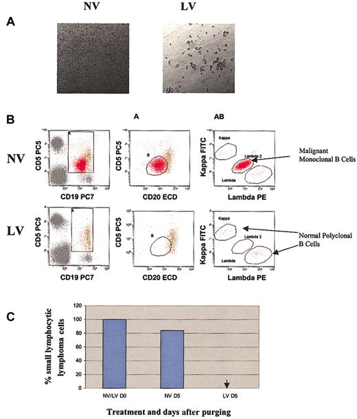 Figure 7. Purging effect of reovirus on SLL cells. (A) Cytopathic effect of reovirus on human SLL cells 72 hours after infection. Purified cells were infected with reovirus (40 MOI), and cells were photographed 72 hours after infection (original magnification, × 200). Cytopathic effect was seen in reovirus-infected but not in uninfected cells. (B) Flow cytometric analysis of SLL following reovirus purging. Apheresis product cells were mixed with SLL cells (10%) and purged for 5 days with reovirus. Samples were analyzed using flow cytometry. Dim CD5+CD19+CD20+ B cells were gated using 2 regions (A and B) and assessed for clonality. The λ-positive SLL cells were clearly distinguished from the normal polyclonal B cells. (C) Representative histograms of viable SLL cells before and after purging with reovirus. The arrow indicates that SLL cells were not detected.