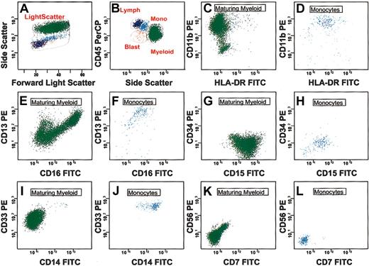 Figure 1. Normal myeloid antigen expression and relationships in bone marrow. (A-B) SSC, FSC, and CD45 intensity in marrow cells from a healthy donor. Promyelocytes contain primary granules giving rise to the high SSC signal. Later stage neutrophils are marked by a decrease in SSC related to the appearance of secondary granules. (C-D) CD11b and HLA-DR show a characteristic relationship in normal maturing myeloid cells and monocytes that follow maturation stages. Normal monocytes retain HLA-DR throughout their development in contrast to neutrophils that rapidly lose this antigen at the promyelocyte stage. The maturation of monocytes is first identified by the rapid appearance of CD11b while maintaining intermediate levels of CD45. (E-F) CD13 is a unique antigen that appears, disappears, and reappears relatively quickly during normal myeloid development. Normal myeloblasts and promyelocytes express high levels of CD13. The antigen is lost on myelocytes and then gradually emerges again as the cells develop to the segmented neutrophil stages. CD13 and CD16 are normally expressed in a consistent “concave” pattern as shown in panel E. Normal monocytes show heterogeneous coexpression of CD13 and CD16. (G-H) Progression from the myeloblast stage to more mature myeloid cells involves acquisition of high levels of CD15 with loss of CD34 and HLA-DR, whereas mature monocytes maintain dim expression of CD15 and lack CD34. (I-J) As myeloid cells mature, there is a slight decrease in CD33 intensity. Early stages of monocyte development are accompanied by increases in both CD13 and CD33 expression. Later stages of monocyte development are defined by the coordinated increase in both CD45 and CD14. (K-L) Maturing myeloid cells and monocytes are normally negative for CD56 and CD7.