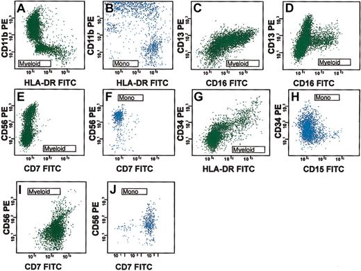 Figure 3. Examples of various myeloid and monocytic aberrant antigenic patterns in MDS. (A) Abnormal retention of HLA-DR in subpopulations of maturing myeloid cells. (B) Abnormal development in a subpopulation of monocytes that lack CD11b. (C) An abnormal “convex” rather than “concave” relationship between CD13 and CD16. (D) Aberrant lack of maturation to CD16. (E-F) CD56 expression on a subpopulation of myeloid cells and a population of monocytes with bright abnormal CD56 expression. (G-H) Abnormal, dim CD34 expression on maturing myeloid cells and monocytes. (I-J) Presence of CD7 on maturing myeloid cells and monocytes.
