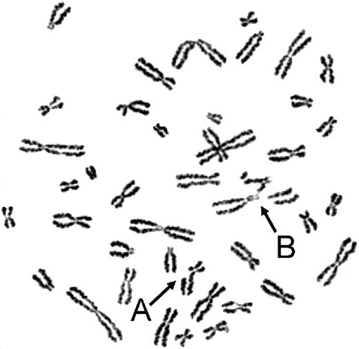 Figure 1. UoC-M1 is sensitive to chromosomal breakage and radial formation following MMC treatment. Arrows indicate representative chromosomal anomalies in UoC-M1: (A) single chromatid break and (B) complex chromosomal rearrangement with at least 2 chromosomal breaks and one end-to-end fusion (radial). Such findings in clastogen-treated cells represent the clinical diagnostic laboratory standard for Fanconi anemia. UoC-M1 also demonstrated occasional, low-level chromosomal breakage without clastogen treatment, although most of the untreated cells had no evidence of instability. No radial forms or cells with multiple chromosomal breaks were ever noted in untreated specimens (of more than 500 total metaphases analyzed), although cells with single breaks were occasionally noted (maximum of 20% in an untreated specimen that when clastogen treated in a simultaneously prepared, parallel flask demonstrated 26% breakage with up to 3 breaks per cell and 38% radial formation; data not shown).