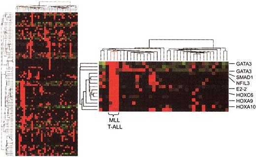 Figure 1. Hierarchic clustering analysis (unsupervised) of gene expression in T-ALL. Partial view of the hierarchic tree of genes (rows) and samples (columns), with MLL-ENL+ T-ALL cases (lines highlighted in red). Gene expression levels are indicated by different shades of red (higher expression) and green (lower expression). The detailed view of the cluster of genes associated with MLL-ENL cases demonstrates the involvement of HOX genes and other transcription factors associated with hematopoietic differentiation.